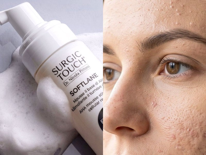 Acne e imperfezioni